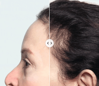 Keranique Hair & Scalp Health Supplements