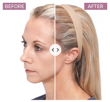 Animated photo of the before and after results when using the Keranique Hair Regrowth System